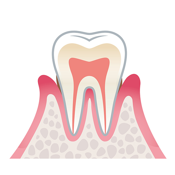 軽度（歯肉炎〜初期）
