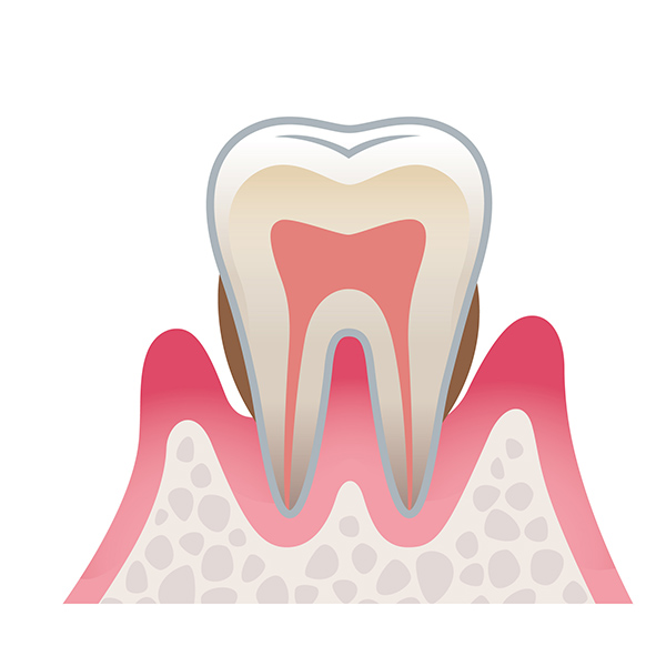 中度（歯周炎の進行）