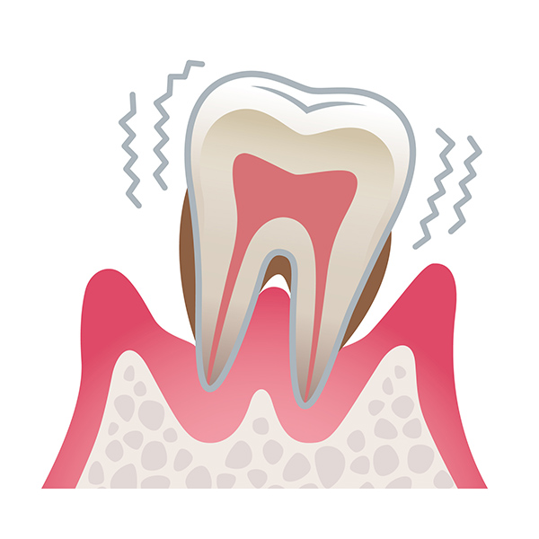 重度（末期症状）