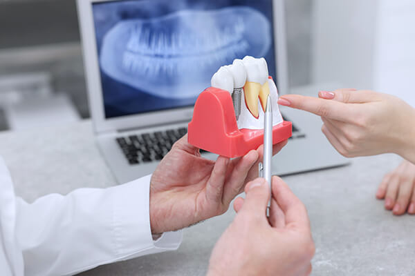高度インプラント治療に対応